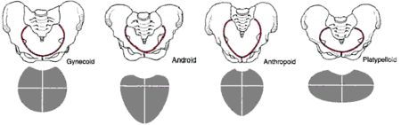  Common female pelvic shapes and their effect on birth canal dimensions.